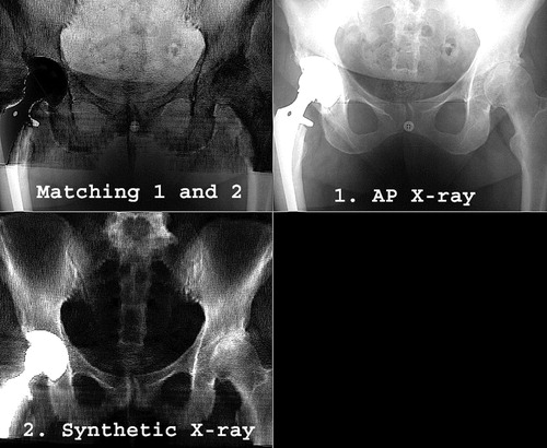 Figure 3. Computer screen view of the Xalign software interface. A real postoperative AP pelvic X-ray was loaded at upper-right, while a synthetic pelvic X-ray, generated by the software using the CT data, occupied the lower-left quarter. The best possible intensity match between the two images was obtained by overlaying them (upper-left). The anatomic reference system, defined on CT images, was thereby transferred to the examined postoperative X-rays.