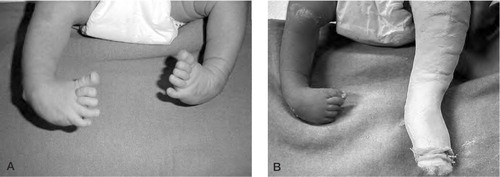 Figure 1. A. Newborn with bilateral congenital clubfoot. B. After manipulation and first casting of left foot.