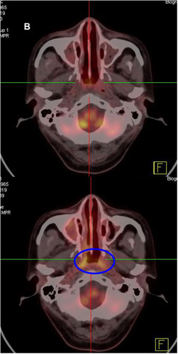 Figure 1 Comparison of PET-CT images before (July 2019) and after (November 2019) the PCET treatment in patient 1. (A) The value of standardized uptake value (SUV) of the mass (it can be seen in the blue coil) in the right nasal cavity was 5.0 in July 2019. In the upper part of the figure, we can see that the mass of the right nasal cavity was gone, and the SUV value of nasal mucosa reduced to 3.0 after 4 cycles of treatment. (B) The SUV value of the nasopharynx (it can be seen in the blue coil) was 25.2 in July 2019 before the PCET treatment. In the upper part of the figure, we can see that the nasopharyngeal metabolic value decreased significantly (SUV= 5.0) in November 2019. The inflammation of the nasal cavity and sinuses had also improved obviously in November 2019.