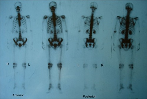 Figure 6 Single-photon emission computed tomography of total skeletal bones showed no other metastases.