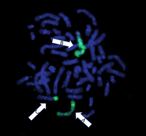 Figure 3 Whole chromosome 5 paint with green fluorescent probes. Arrow A shows the normal chromosome 5 with fluorescence label seen throughout the chromosome indicating intact chromosomal material. Arrow B shows the derivative chromosome 5; the unlabeled end of the long arm indicates the translocated chromosomal material from the derivative chromosome 7. Arrow C shows the derivative chromosome 7 containing translocated material from the der(5).