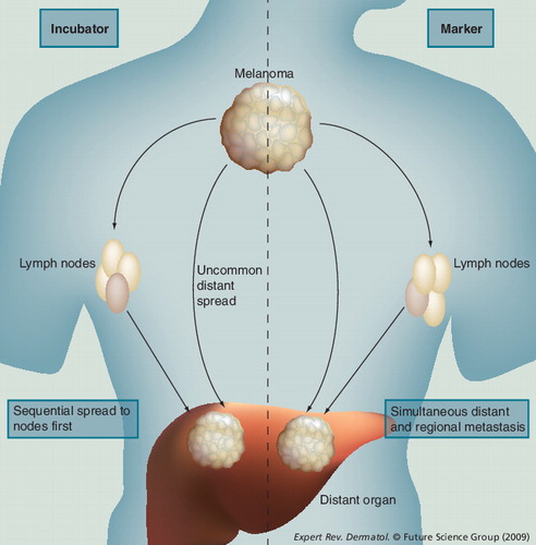 Figure 1. Schematic representation of two competing hypotheses for nodal metastases.The incubator hypothesis: primary melanoma spreads first to regional draining nodes and only subsequently to distant sites. The marker hypothesis: spread occurs simultaneously to nodal and distant sites.