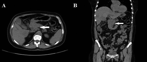Figure 1. CT scan of the abdomen and pelvis showing large mass in the head of pancreas with multiple hypodense lesions in the liver in (a) axial view and (b) coronal view (arrows).
