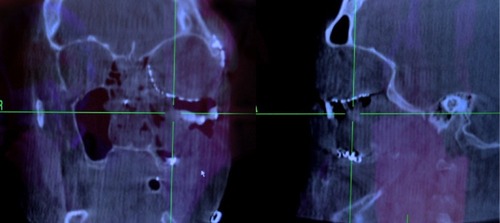 Figure 2 Example of an intraoperative CT scan used to evaluate placement of an orbital floor titanium implant.