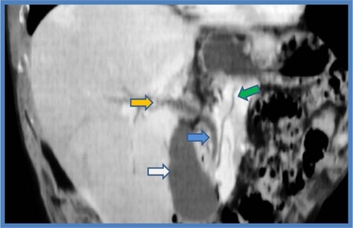 Figure 6 CTCP with minimum intensity projection.