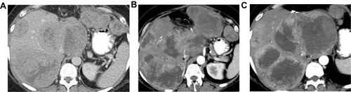 Figure 3 Axial CT images of the liver with advanced HCC: pretreatment (A) and post-treatment with Sorafenib (2 months interval (B) and 4 months interval (C)). Lesions demonstrate slightly increased size but decreased enhancement, suggesting treatment response.