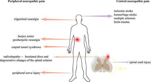 Figure 1 The types of neuropathic pain.