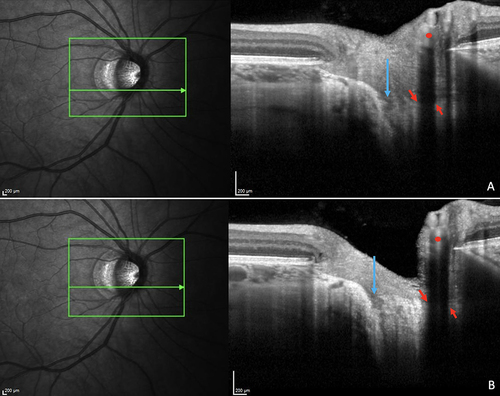 Figure 4 Illustration of a lamina cribrosa defect. Highly myopic eye. Refraction: - 8.6 D, Axial Length: 28.34 mm. Adjacent serial OCT sections (A and B) of the optic nerve head illustrating a lamina cribrosa defect (blue arrows). We were careful not to confuse lamina cribrosa defect with shadows (red arrows) of the vessels (red dots).
