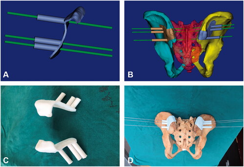 Figure 2. 3D printing guide plates for sacroiliac screws insertion. (A, B): guide plates were designed based on the selection of posterior superior iliac spine; (C): solid diagram of guide plates; (D): guide plates fitting assisted sacroiliac screws insertion.