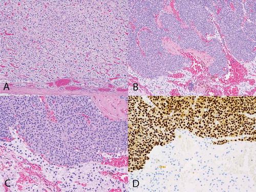 Figure 3. Histological findings of the patient. (A) Hematoxylin & eosin stain showing adrenal cortical adenoma with a capsule of adenoma noted at the bottom of the image (100×). (B) Metastatic breast carcinoma (top of image) and adrenal cortical adenoma (bottom) (100×). (C) Metastatic breast carcinoma (top of image) and adrenal cortical adenoma (bottom) (200×). (D) GATA-3 immunohistochemical stain showing metastatic breast carcinoma (top of image) and adrenal cortical adenoma (bottom). The metastatic breast carcinoma shows positive nuclear staining (brown) with the GATA-3 antibody consistent with breast carcinoma, while the cells of the adrenal cortical adenoma are negative for that stain (200×).