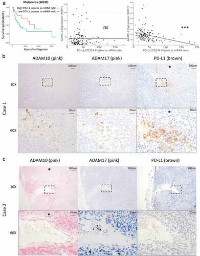 Figure 3. Primary melanoma ADAM10 and ADAM17 staining correlates negatively with PD-L1 staining. (a) Cases of melanoma were divided by high versus low protein-to-mRNA ratio (cutoff 3.59E-6) and overall survival, ADAM10 expression, and ADAM17 expression were compared by Cox proportional hazards testing and unpaired Student’s t-test, respectively. Similar analyses across the TCGA dataset are reported in Table 1, Supplemental Figure 1, and Supplemental Tables 1–2. Primary melanoma samples were stained for ADAM10 (pink, column 1), ADAM17 (pink, column 2), and PD-L1 (brown, column 3) by immunohistochemistry (IHC). 10x and 60x magnification shown for each sample. Dashed rectangle in the 10x magnification images (row 1) denotes the area of 60X magnification (row 2). An asterisk (*) denotes moderate to intense staining as scored by a pathologist. (b) In Case 1, melanoma cells stained positively for PD-L1 but not for ADAM10 or ADAM17. (c) In Case 2, melanoma cells stained positively for ADAM10 but not for ADAM17 or PD-L1. Additional cases in Supplemental Figure 7A-D. Fisher’s exact test showed significant negative correlation between ADAM10/ADAM17 and PD-L1 staining (odds ratio 0, CI 0–0.832, p = .018; see Supplemental Figure 7E)