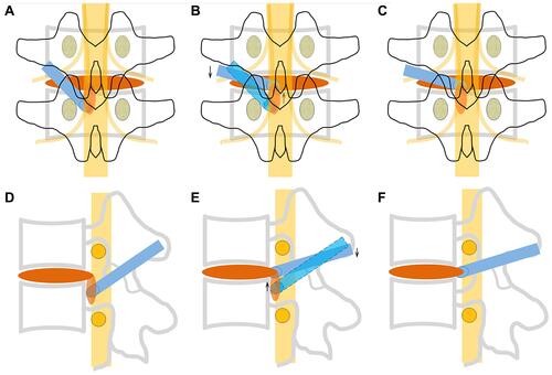 Figure 4 Schematic illustration of the adjustment of the working cannula under the endoscope ((A–C), anteroposterior; (D–F), sagittal). Blue represents the working cannula. Yellow represents nerve roots and spinal cord. Red represents intervertebral disc tissue. Black and gray represent vertebrae.