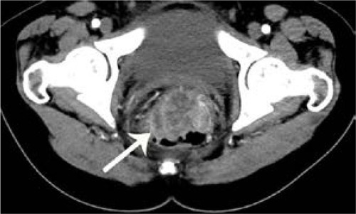 Figure 2 Computed tomography scan of 55-year-old man with nonmucinous carcinoma in rectum.