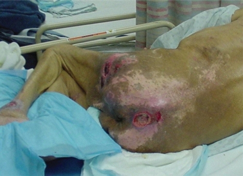 Figure 9 Full body view, multiple ulcers.