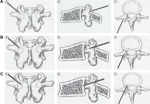 Figure 3 Diagrams for pedicle screw insertion.