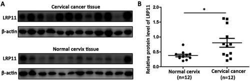 Figure 1 LRP11 expression in normal and cervical cancer tissues. (A) Protein expression of LRP11 was determined by Western blotting in 12 normal cervical tissues and 12 tumor tissues. (B) Quantification of protein expression levels as shown in A. *P<0.05.