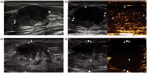 Figure 4. Nonconcentric type of ablation in a 26-year-old woman. (a) A clear tumour (arrow) in US is observed before MWA. (b) Enhancement of the tumour is observed in CEUS before MWA. (c) The shrank tumour (arrow) is still clear in US Week 1 after ablation. (d) The tumour (arrow) does not locate in the centre of the ablation zone (arrow-head) in CEUS.