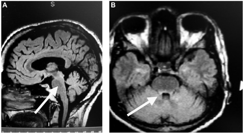 Figure 3 MRI 5 months following treatment with ACTH gel for 5 days, followed by monthly IV natalizumab.