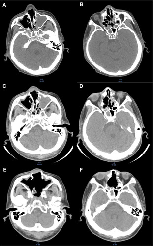Figure 1 Computed tomography (CT) at the level of the maxillary sinus (A and C and E) and the ethmoid sinus (B and D and F). (A and B) The nasal septum fracture and soft tissue density in sinus cavity were observed at the onset, those were not remarkable changed just before endoscopic sinus surgery (C and D). (E and F) Follow-up CT scan after endoscopic surgery (before additional surgery) showed the removal of fractured nasal septum and the improvement of mucosal thickening.