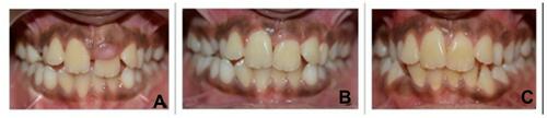 Figure 6 (A) Preoperative clinical picture.; (B) 6 months after surgery; (C) 18 months after surgery.