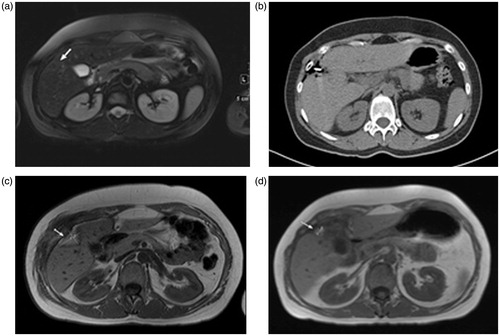 Figure 2. Transverse images of a 40-year-old man with liver metastasis from colorectal cancer treated with high-frequency microwave ablation (HF-MWA). (a) MR image (T2 weighted) obtained 4 weeks prior to MWA shows metastasis (arrow) in segment 5 with a maximum diameter of 17.3 mm and a volume of 9.07 mL. (b) Computed tomography (CT) image obtained during MWA (5 min, 76 W). (c) MR image (T1 weighted) obtained 24 h after successful treatment shows typical coagulation (volume: 23.19 mL, max. diameter: 9.02 mm). (d) MR image (T1 weighted) 48 months (volume: 2.18 mL) after MWA shows area of scarring and no progression of the tumour.
