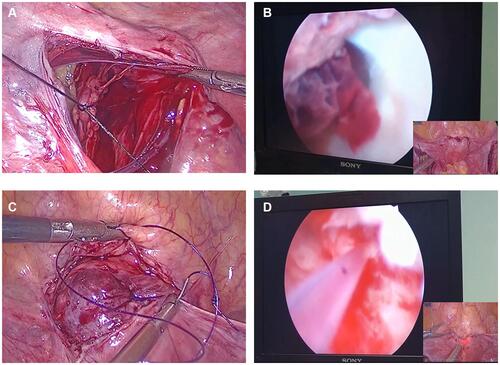 Figure 1 The modified hysteroscopic-laparoscopic surgery. (A) The sham ligation of the uterine artery; (B) hysteroscopic removal of pregnancy tissue; (C) laparoscopic diverticulum inverting suture; (D) hysteroscopy affirms the repair of the uterine scar defect.