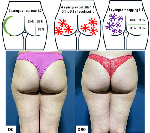 Figure 9 Case 5, Buttocks Beautification 3D. Schematic representation of the injections (above). Standardized posterior images pre and 90 days post injection (below). Each syringe = 1.5 mL of CaHA.