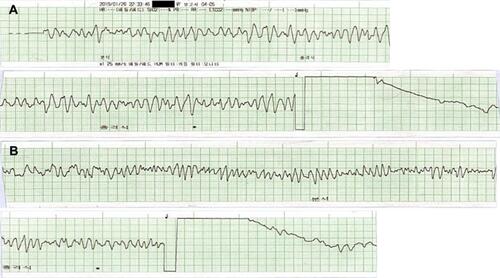 Figure 1 Prehospital electrocardiographic recordings of the patient. The recordings showed the first (A) and second (B) defibrillation after detection of ventricular fibrillation by automatic external defibrillator.