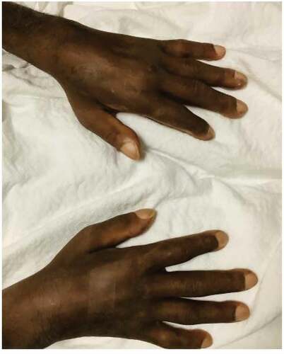 Figure 1. Bilateral soft tissue swelling of the hands with loss of skin crease and clubbing of the fingers