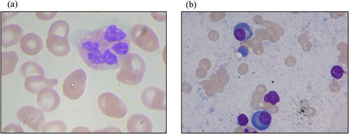 Figure 1. Examples of microscopic images: (a) normal blood microscopic image, (b) blood microscopic image with leukemia (Gupta et al., Citation2018, Citation2020).