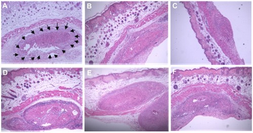 Figure 2 (A–F) Histological images of subcutaneous tumor nodules taken from nude mice implanted with CaSki cells. (A) Arrows indicate the malignant tumor present in the deep portion of the skin of 14-day HPV-Veh mice (×4). Tumor area of 14-day HPV-300AE (B), 14-day HPV-3000AE (C), 28-day HPV-Veh (D), 28-day HPV-300AE (E), and 28-day HPV-3000AE (F) (×4).Abbreviations: HPV, human papillomavirus; Veh, vehicle; AE, Acanthus ebracteatus Vahl crude extract.