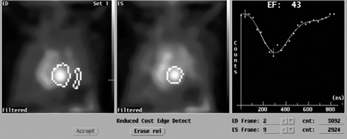 Figure 3.  MUltiple Gated Acquisition (MUGA) scan showing left ventricular ejection fraction (LVEF), end-diastolic (ED) diameter and end-systolic (ES) diameter 6 months after the start of therapy for cardiac symptoms.