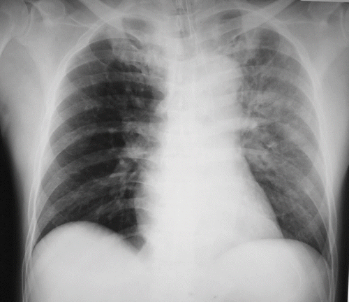Fig. 1.  Chest x-ray of Case 2.