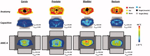Figure 14. Transversal slices of the simulated temperature distribution for small cervix, prostate, bladder and rectum cancer patients heated with capacitive electrodes using overlay boluses or the radiative AMC-4 system. Electrode sizes top + bottom were 25 + 25 cm (cervix, prostate, rectum) and 15 + 25 cm (bladder). The maximum temperature in all distributions is 44 °C. The total power absorbed in the patient (Ptot) and in the target region (Ptarget) is indicated for each distribution. Cross-sections are at the centre of the target region in axial direction. The contour in the temperature distributions indicates the target region.