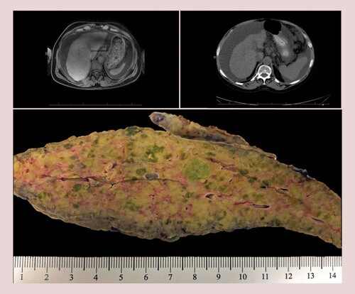 Figure 1. Case 2: magnetic resonance imaging without contrast with cirrhosis only (top left); subsequent computed tomography abdomen and pelvis without contrast with cirrhosis only (top right). Imaging limited due to lack of contrast due to patient glomerular filtration rate and concurrent end-stage kidney disease. Gross appearance: note the diffuse involvement of the liver parenchyma by innumerable pale, green, cholestatic sub-centimeter nodules that were found to harbor hepatocellular carcinoma at microscopic examination. The pale and cholestatic appearance of these nodules is a subtle clue on macroscopic examination for targeted sampling (bottom center).