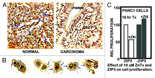 Figure 2. ZIP3 transporter and zinc treatment effects on cell proliferation. (A) Immunohistochemical identification of ZIP3 transporter in adenocarcinoma and normal human pancreatic tissue sections. Blue arrows show basal membrane localization of transporter in normal ductal and acinar epithelium. Black arrows show the absence of plasma membrane transporter in ductal adenocarcinoma and in PanIN epithelium. (B) Blue arrows show the presence of plasma membrane ZIP3 transporter in Panc1 cells. (C) Shows the effect of zinc treatment on proliferation of wildtype Panc1 cells that exhibit ZIP3 transporter and on Panc1 cells with downregulated ZIP3 (i.e., Panc1/ZIP3 cells vs. Panc1/-ZIP3 cells).