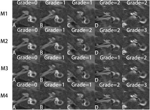 Figure 2. Evaluation of the five patients(A–E) using four different methods for cochlear EH grading. M1 = Nakashima et al. [Citation8]; M2 = Gürkov et al. [Citation9] and Yang et al. [Citation6]; M3 = Baráth et al. [Citation10] and Bernaerts et al. [Citation11]; M4 = He et al. [Citation12].