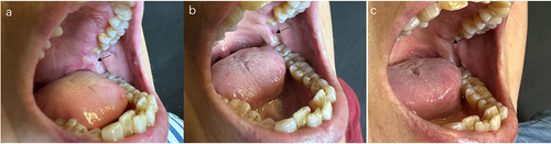 Figure 1 Mucous membrane pemphigoid with the oral predominant response to abrocitinib therapy. (a) before the abrocitinib therapy. (b) Two weeks later after the abrocitinib therapy. (c) Four weeks later after the abrocitinib therapy.