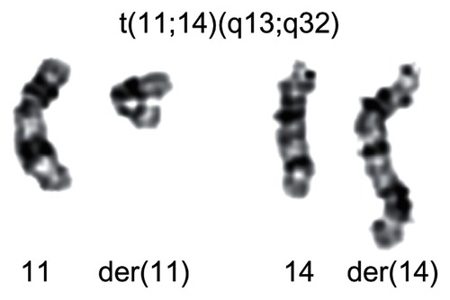 Figure 1 The translocation t(11;14)(q13;q32) is a nonrandom chromosomal rearrangement in Mantle cell lymphoma.