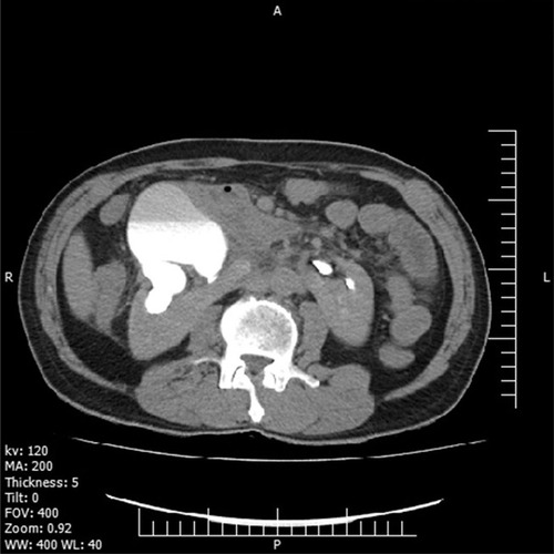 Figure 2 CT-IVU pointing right renal pelvic and lower calyces.