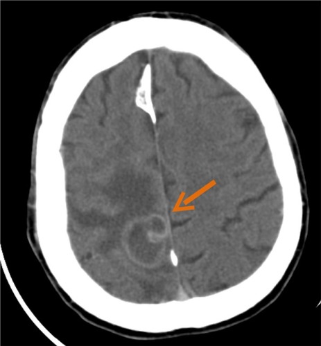 Figure 9 Computed tomography scan revealing a right temporoparietal abscess (arrow) with perilesional edema.Note: Actinomyces meyeri was found in cultures.