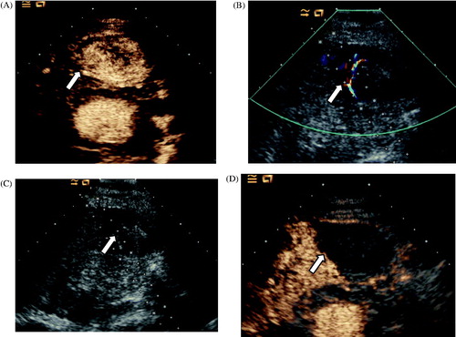 Figure 4. Ablation in a 76-year old man with hepatocellular carcinoma adjacent to the LMA in segment III. (A) CEUS obtained before ablation showed obvious enhancement in the arterial phase (arrow). (B) Colour Doppler ultrasonography depicts feeding arteries entering the tumour on the right side (arrow). (C) A small dose of ethanol was injected via a 21-gauge PTC needle to block the feeding arteries (arrow). (D) CEUS obtained 3 days after ablation showed no enhancement of the target lesion (arrow).