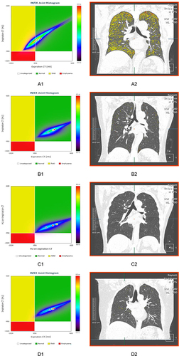 Figure 5 PRM and CT manifestations of four subjects. Subject A with the ratio of FEV1 and FVC was 0.74 and FEV1% predicted value was 71%, was assigned to high-risk whatever FEV1% threshold was. And this was verified by fSAD that was shown in PRM and CT manifestations. Subject B with FEV1/FVC of 0.77 and FEV1% predicted value of 78%, was divided as high-risk group according to 80% predicted value and subject C with FEV1/FVC of 0.87 and FEV1% predicted value of 80%, was also divided as high-risk group to 95% predicted value. Subject B and C were divided into normal group when FEV1% predicted value was 72%, CT finding and PRM of them was normal. Subject D was divided as normal group for FEV1/FVC of 0.94 and FEV1% predicted value of 97%, and the CT finding and PRM were normal.