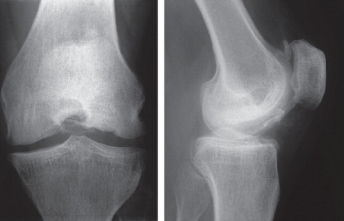 Figure 4.  Subject III:6. Left knee at age 40. The femoral condyles are flattened and there is obvious osteoarthritis. A separate bone fragment dorsal to the patella is seen in the lateral view.