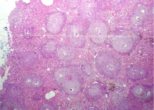 Figure 2 A liver tissue section of a control group showing intact architecture studded with numerous schistosomal granulomas (H&E, ×40).