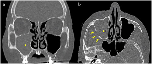 Figure 1. Computed tomography scan showing soft-tissue shadows with calcification (arrowhead) on the right maxillary sinus with partial bone thickening and bone erosion (arrow) in the posterior wall of the maxillary sinus (a: coronal, b: axial).