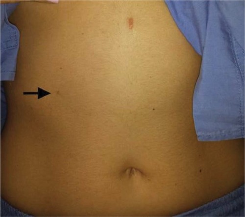 Figure 1 Cosmetic result right after surgery.