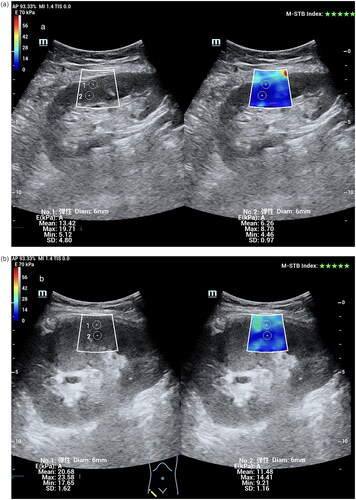 Figure 2. Exemplary SWE images of kidney transplantation recipients who experienced the primary outcome or not. (a) B-mode image and color-coded shear wave elastography (SWE) map in a 47-year-old female who had the kidney transplantation 3 years before the SWE examination, and did not experience the primary outcome during the follow-up time. Regions of interest (ROI) were placed in the anterior aspect of the cortex (1+) and medulla (2+) as shown with the white circle. (b) B-mode image and color-coded shear wave elastography (SWE) map in a 39-year-old male who had the kidney transplantation 2 years before the SWE examination, and experienced the primary outcome (kidney graft deterioration) during the follow-up time. Regions of interest (ROI) were placed in the anterior aspect of the cortex (1+) and medulla (2+) as shown with the white circle.