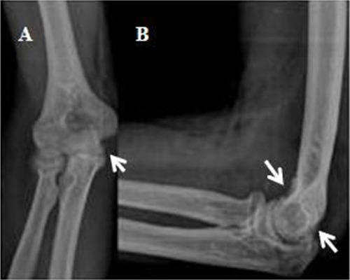 Figure 1 Anterioposterior (A) and lateral (B) radiographs of elbow.
