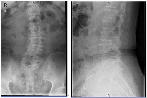 Figure 1 X-ray, Anterior and lateral position of lumbar spine before surgery, L3–5 Vertebral bone destruction.